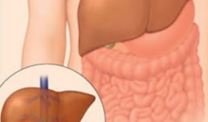hepatitis