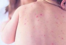 Širi se epidemija morbila i velikog kašlja, nizak postotak vakcinisane djece