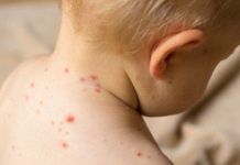 Najzarazniji virus na svijetu ponovno se širi Evropom: Stručnjaci upozoravaju, sve je više slučajeva