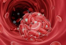 Krvni ugrušci: Provjerite jeste li u rizičnoj grupi