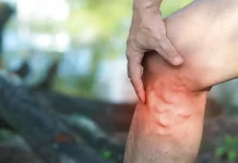 Ovi simptomi mogu biti znak da se u tijelu stvara tromb: Ne ignorišite ih