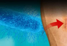 Mala ogrebotina ga zamalo koštala života, sve zbog bakterije koja jede ljudsko meso