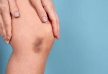 Rani znakovi nedostatka vitamina C koje ne biste smjeli zanemariti