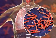 DRAMATIČNO UPOZORENJE SVJETSKE ZDRAVSTVENE ORGANIZACIJE: Tuberkuloza prošle godine ubila više od 1,2 miliona ljudi