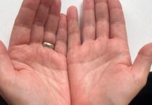 Ako primijetite ovo na rukama, možda imate opasnu bolest