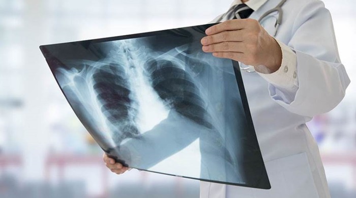 Otkrijte kako možete smanjiti rizik od raka pluća