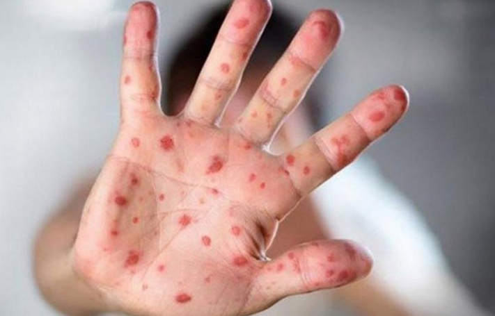 Epidemija morbila u RS-u: U Bijeljini i Banjaluci zaražene 52 osobe