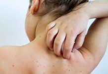 U proteklih sedam dana dva nova slučaja zaraze morbilima u ZDK