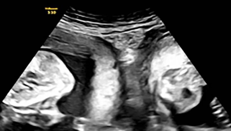 Rijetka pojava zabilježena u Kini: Majka s dvije maternice rodila blizance – po jedno iz svake maternice