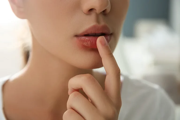 Obratite pažnju na simptome herpesa, ovako ga možete prevenirati…