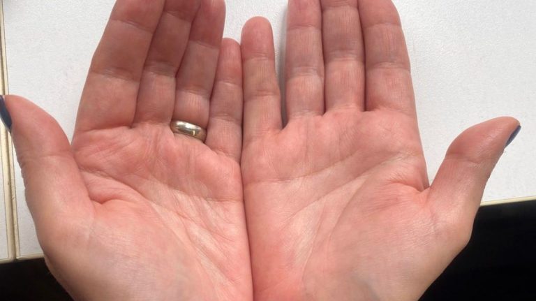 Ako primijetite ovo na rukama, možda imate opasnu bolest